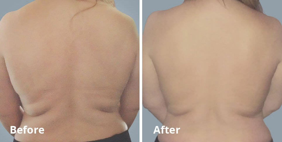 Non-invasive body contouring