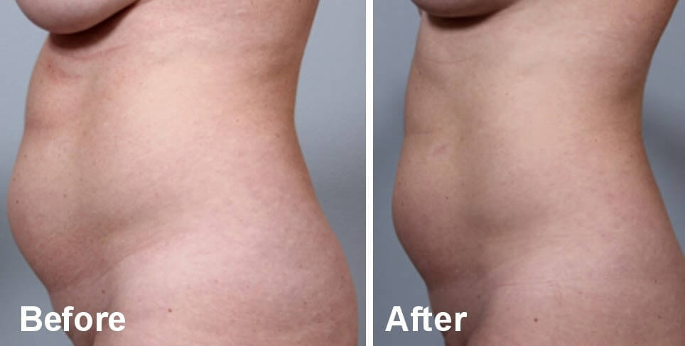 body fx non surgical body contouring before and after non surgical body contouring results