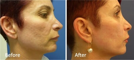 skin resurfacing treatments