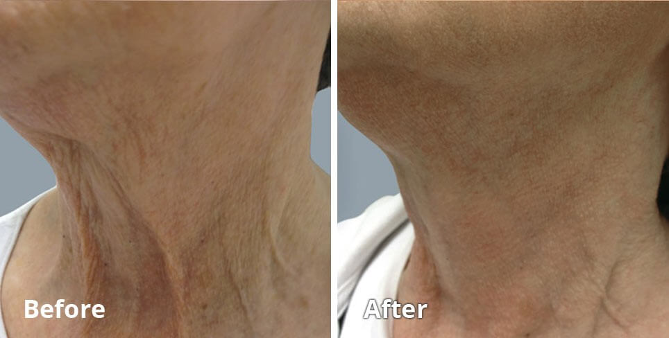 before and after skin resurfacing