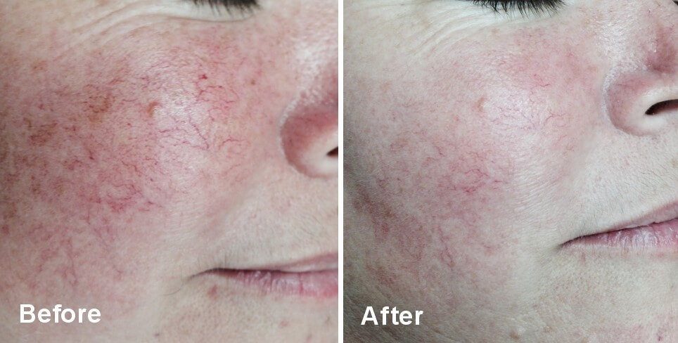 Before and After lumecca skin treatment procedure - Our St Louis Skin Solutions Before and After lumecca skin treatment procedure - Our St Louis Skin Solutions