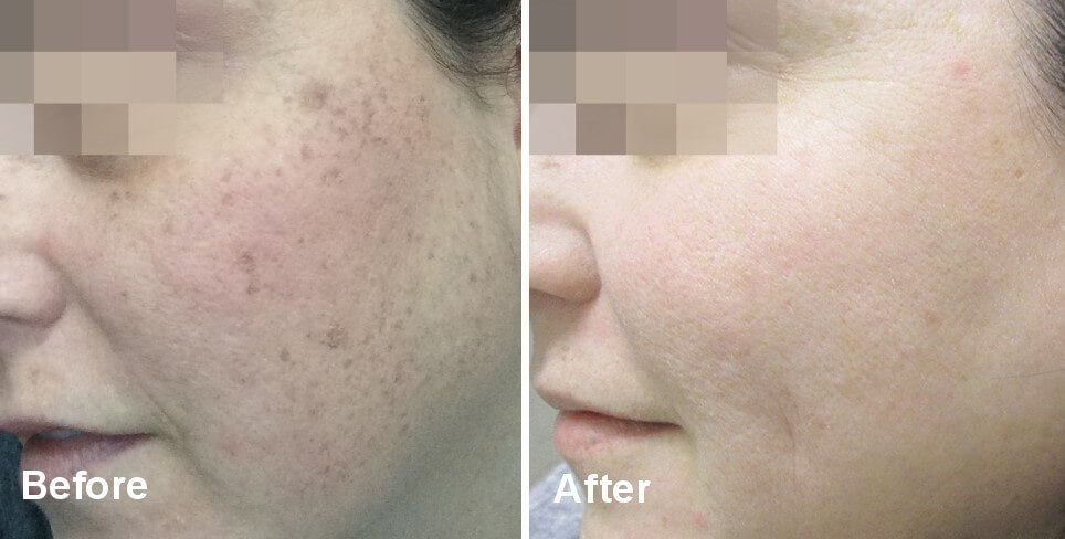 Photo Skin Rejuvenation by Laser Lipo and Veins Skin Care in St Louis Photo Skin Rejuvenation by Laser Lipo and Veins Skin Care in St Louis