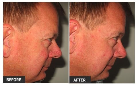 Veinwave Treatment can Treat Facial Veins veinwave treatment for facial veins - Before and After