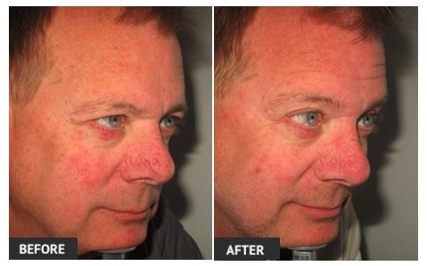 Treat Visible Veins on Nose with Veinwave Treatment Before and After Veinwave on Nose
