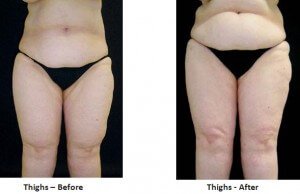 before and after lipedema treatment
