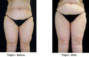 What are some treatment options for lipedema?