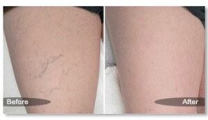 Spider Vein Treatment at St Louis Laser Vein Center