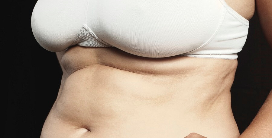 Bra Bulge and Back Fat Liposuction Liposuction and Treatment in
