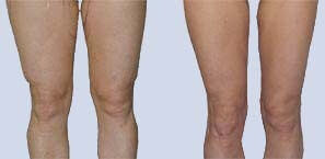 Knees lipo before and after picture