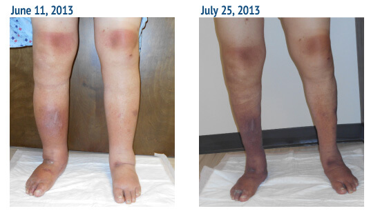 Our Lymphedema Treatment Results in St Louis lymphedema treatment st louis before and after