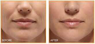 prp before after2