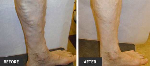 vein disease treatment