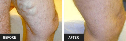 Before and After Picture of Vein Treatment in St. Louis Before and After Picture of Vein Treatment in St. Louis