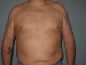 Gynecomastia Patient B-after