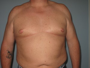 Gynecomastia Patient B before
