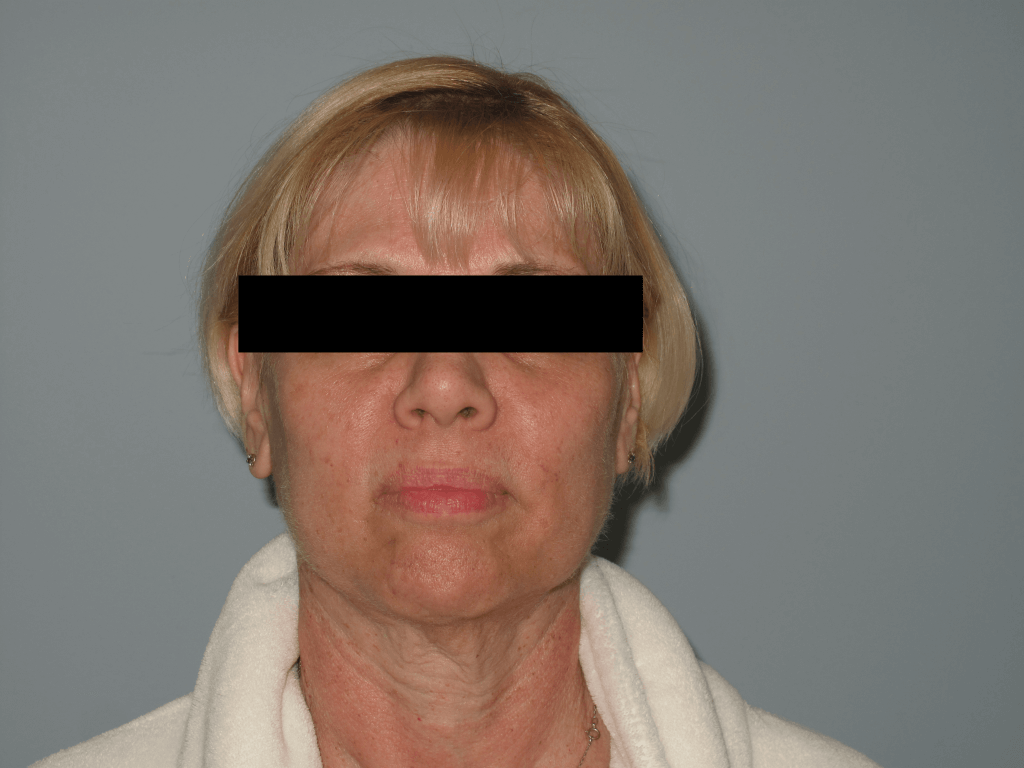 anterior face before-min