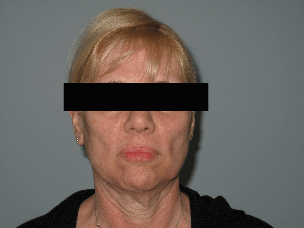 anterior face after-min