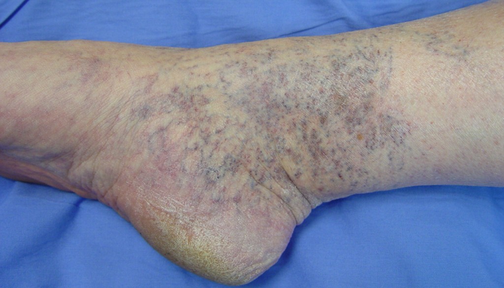 corona-phlebectatica spider veins on ankle