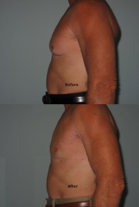 gynecomastia- laser lipo and Vein Center