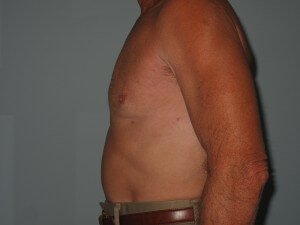 male chest after Patient A