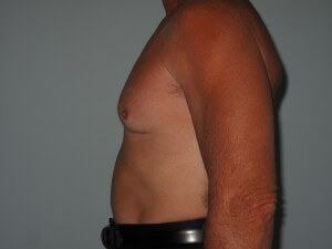 male chest before Patient A