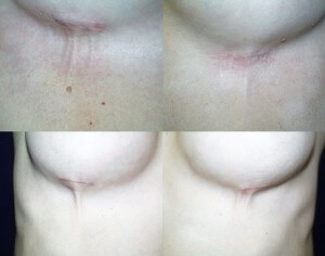 Treat Spider And Varicose Veins On Chest Trunk In St Louis Laser Lipo And Vein Center