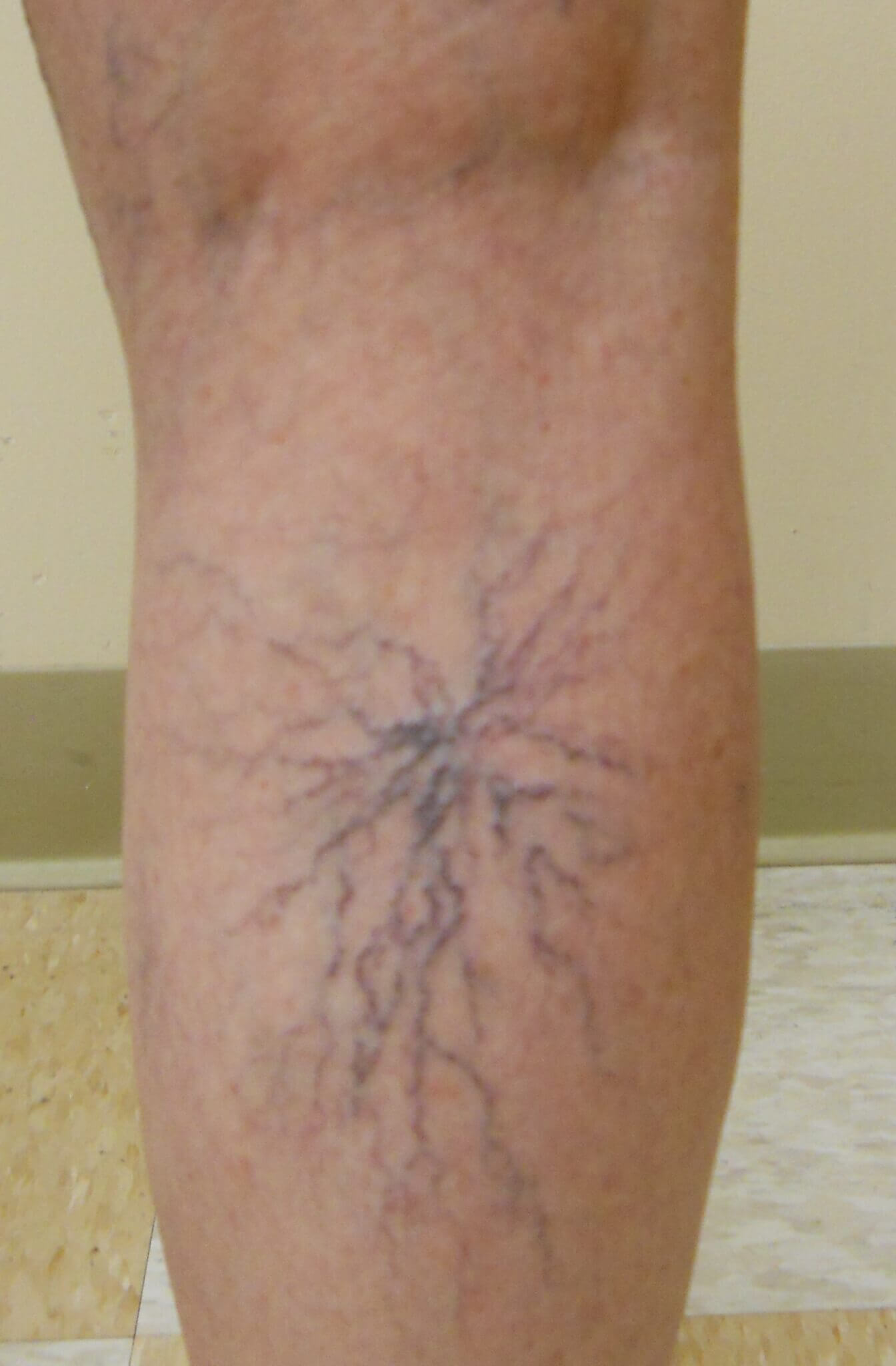 treating-broken-or-spider-veins-laser-lipo