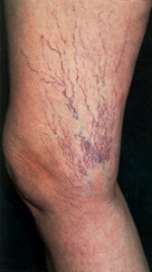 spider veins on side of thigh