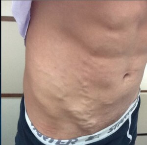 On purple breasts veins Varicose veins