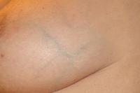 What causes veins in breast to be more visible