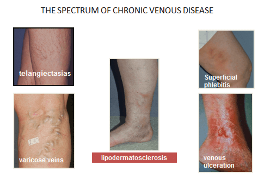 Spectrum of chronic venous disease