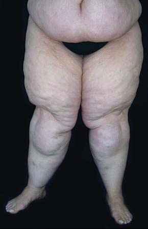 Lipoedema stage 3