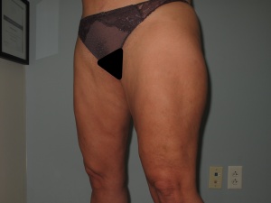 thighs 45 degrees left after-min