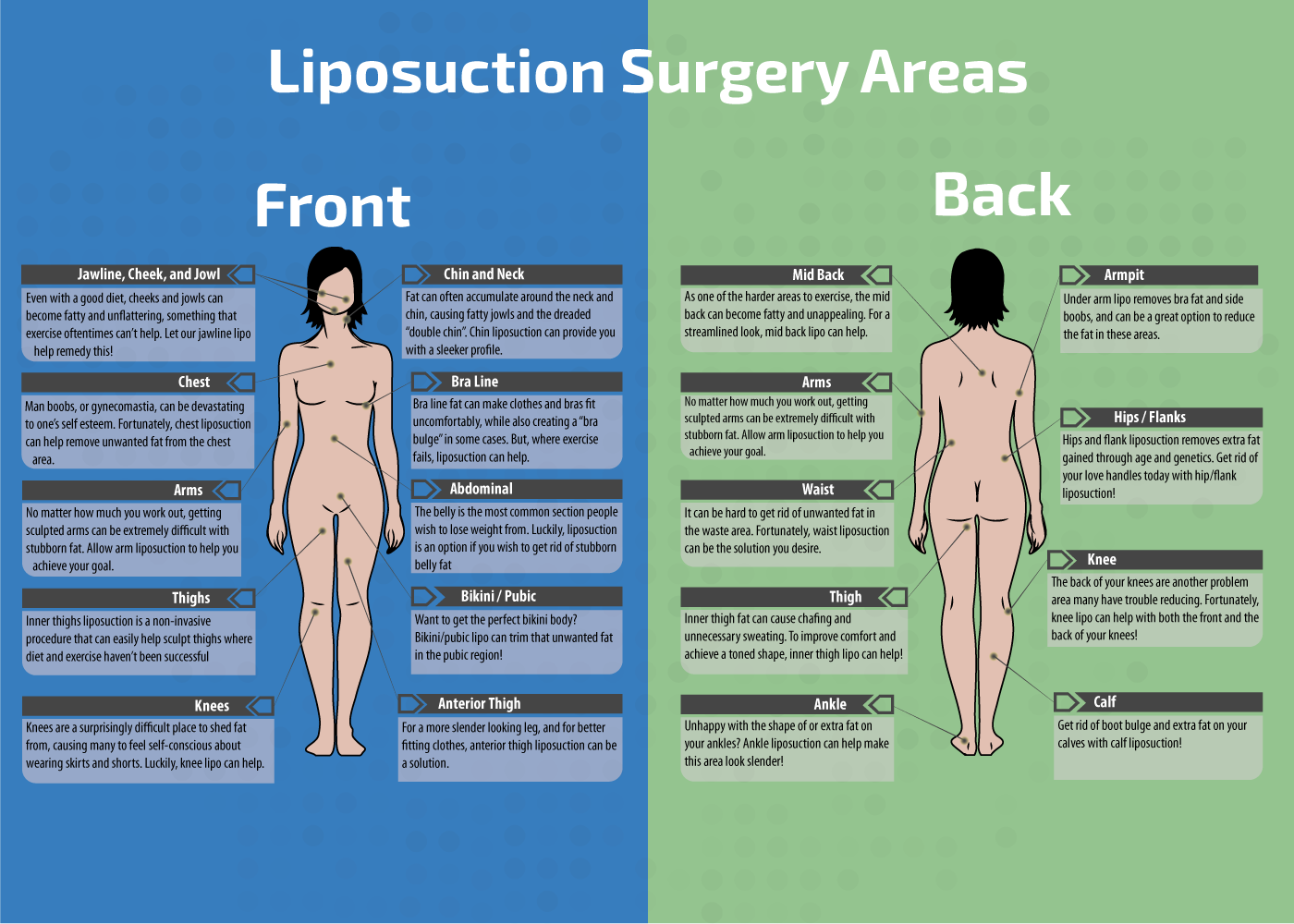 Infographic Showing the Best places to Undergo Liposuction Surgery Liposuction Surgery Areas Infographic