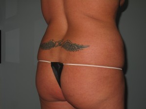 Before Brazilian Butt Lift Surgery Before Brazilian Butt Lift Surgery
