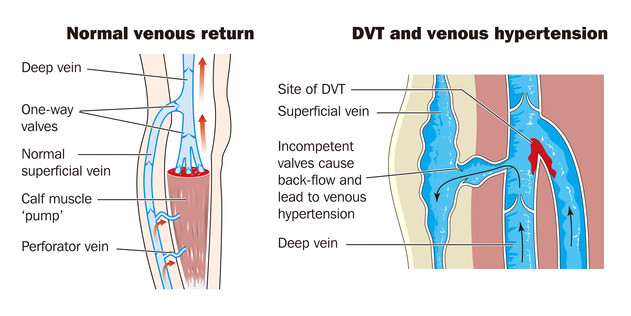 photodune-4854907-deep-vein-thrombosis-xs