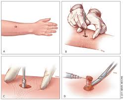 punch biopsy diagram punch biopsy diagram