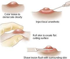 shave biopsy diagram shave biopsy diagram