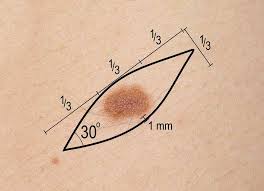 skin excision biopsy diagram skin excision biopsy diagram