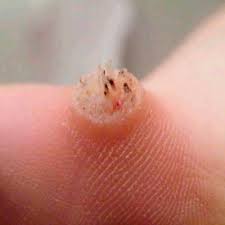 Dermatologist Wart Removal Laser Lipo And Veins Dermatologist Wart Removal Laser Lipo And Veins