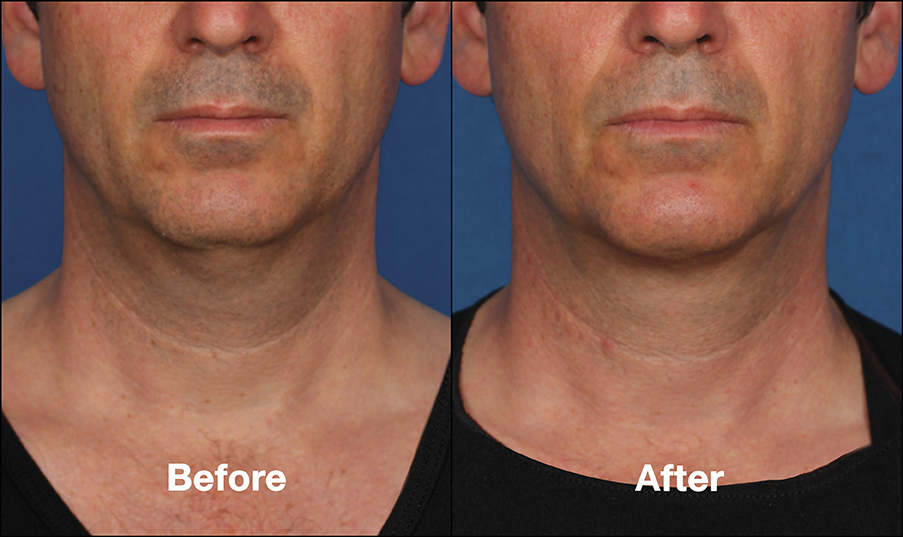 St Louis Kybella Double Chin Treatment Laser Lipo and Veins