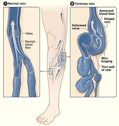 Varicose veins  How to use Compression Stockings for Varicose veins in a  easy way 