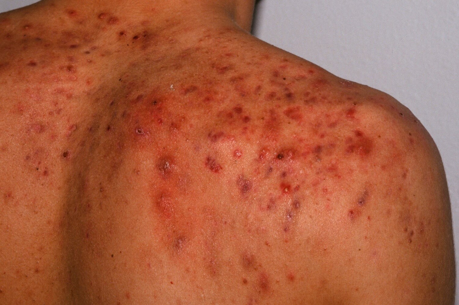 acne patch