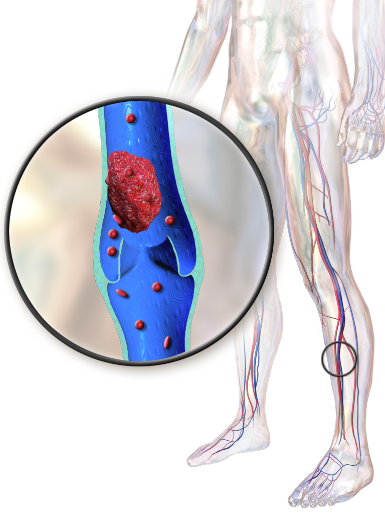Blausen_0290_DeepVeinThrombosis