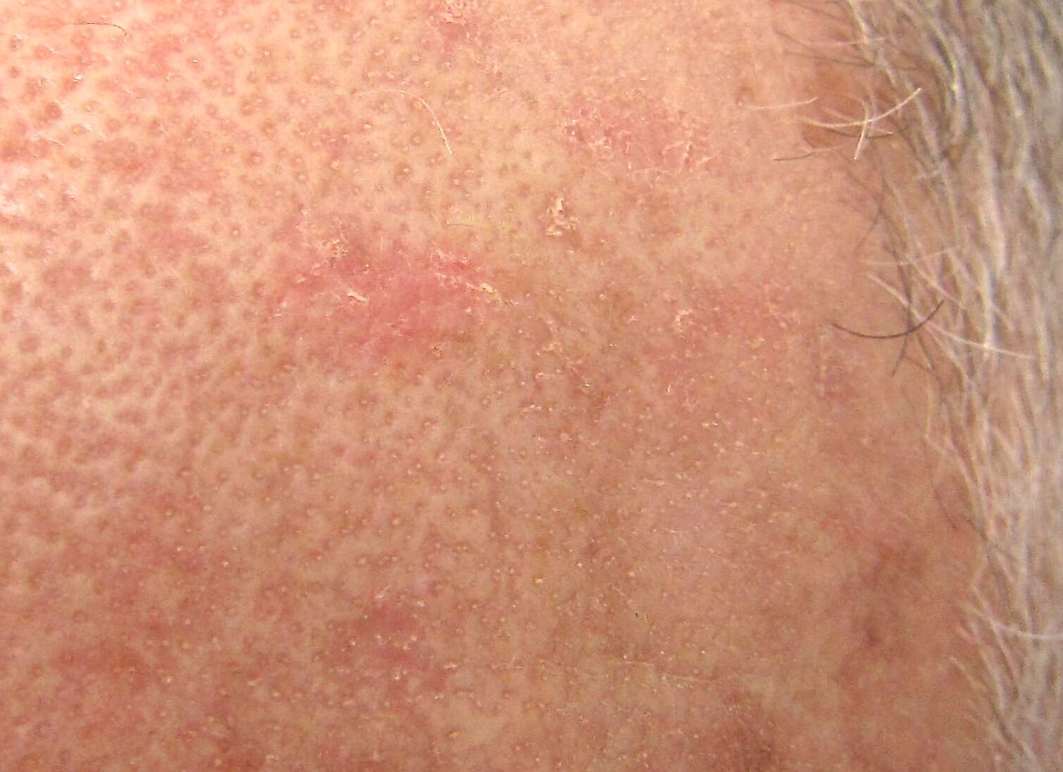 skin-cancer-causes-how-to-avoid-them-laser-lipo-vein-center