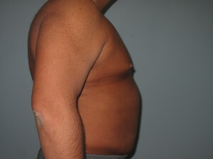 chest right view after-min