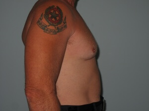 chest right view before 2-min