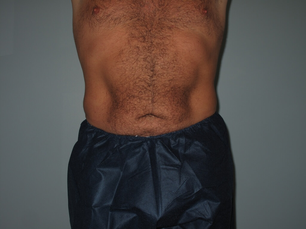 Liposuction Before and After Photos Laser Lipo & Vein Center