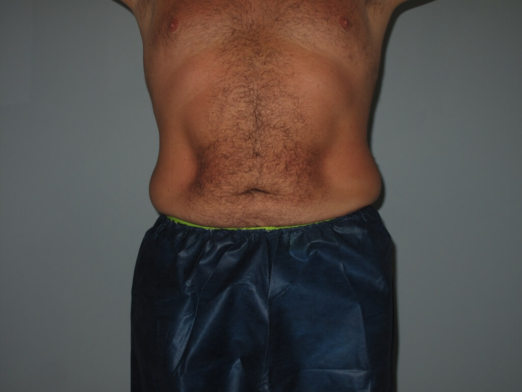 Liposuction Before and After Photos Laser Lipo & Vein Center