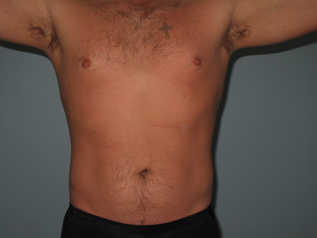 Liposuction Before and After Photos Laser Lipo & Vein Center